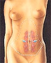 Tummy Tuck Modesto