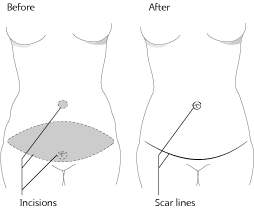 drawing of tummy tuck surgery
